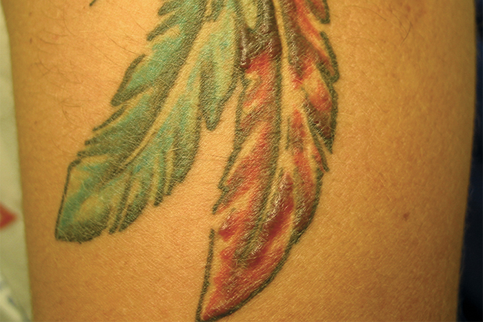 Похожие на шрамы рубцы в области татуировки. Источник: uptodate.com