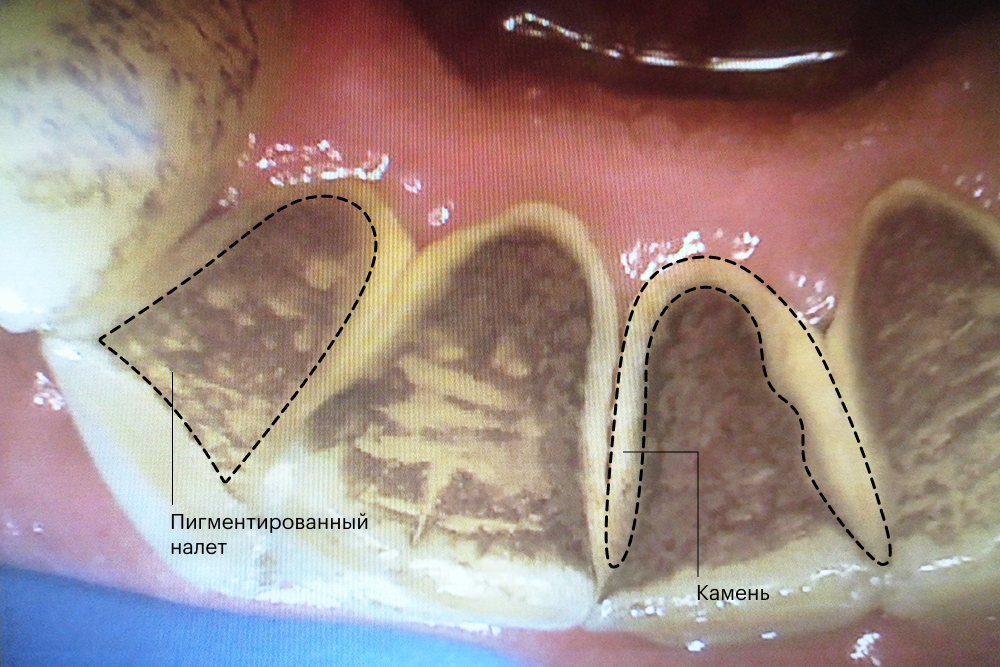 Ирригатор для полости рта: применение, польза и вред