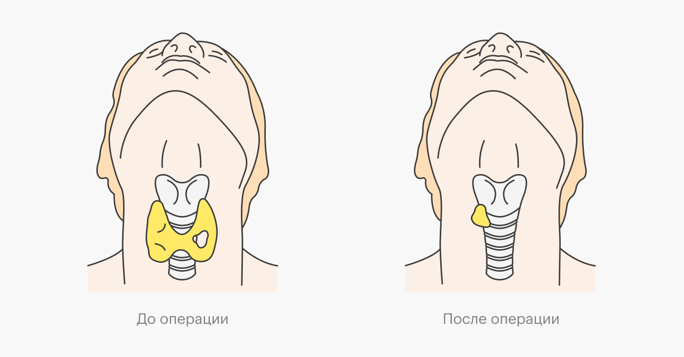 Врач может удалить не всю щитовидную железу, а только ее часть. Это зависит от размеров узла и его вида