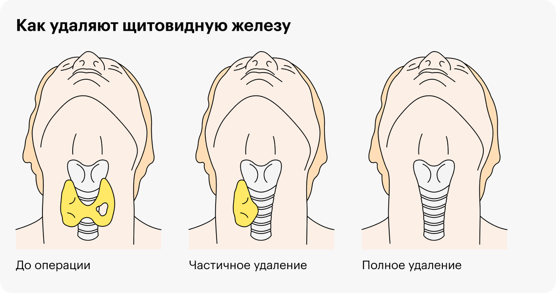 Лечение кисты щитовидной железы