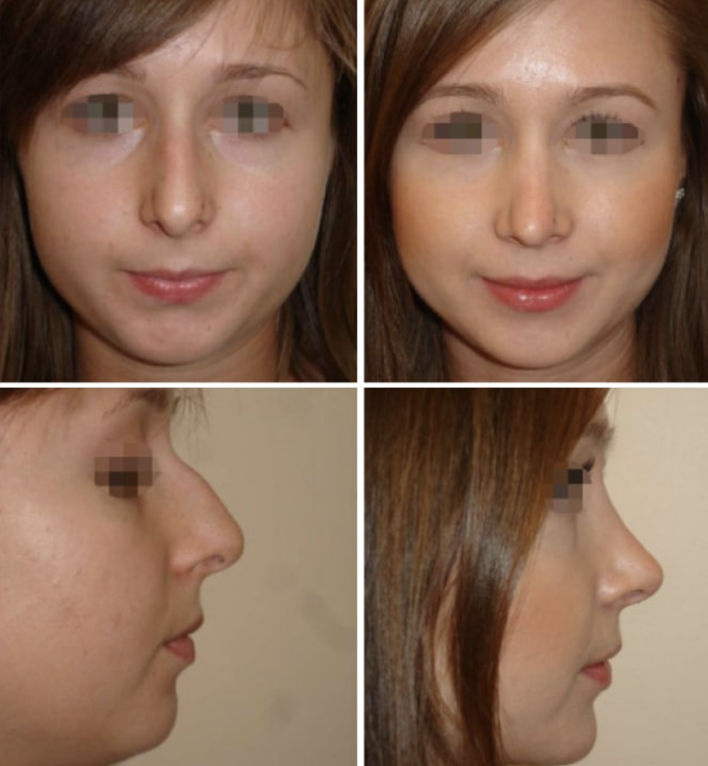 Пример ринопластики с исправлением горбинки носа. Источник: телеграм⁠-⁠канал «emc_beauty»