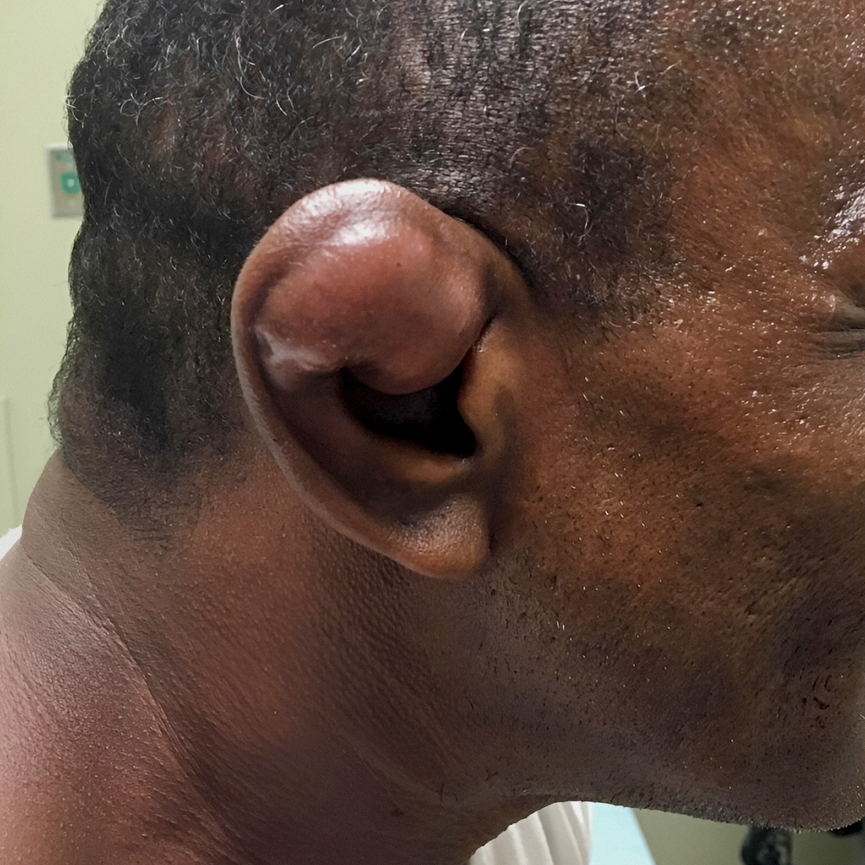 Борцовское ухо с тяжелой степенью деформации. Источник: Национальная библиотека медицины США