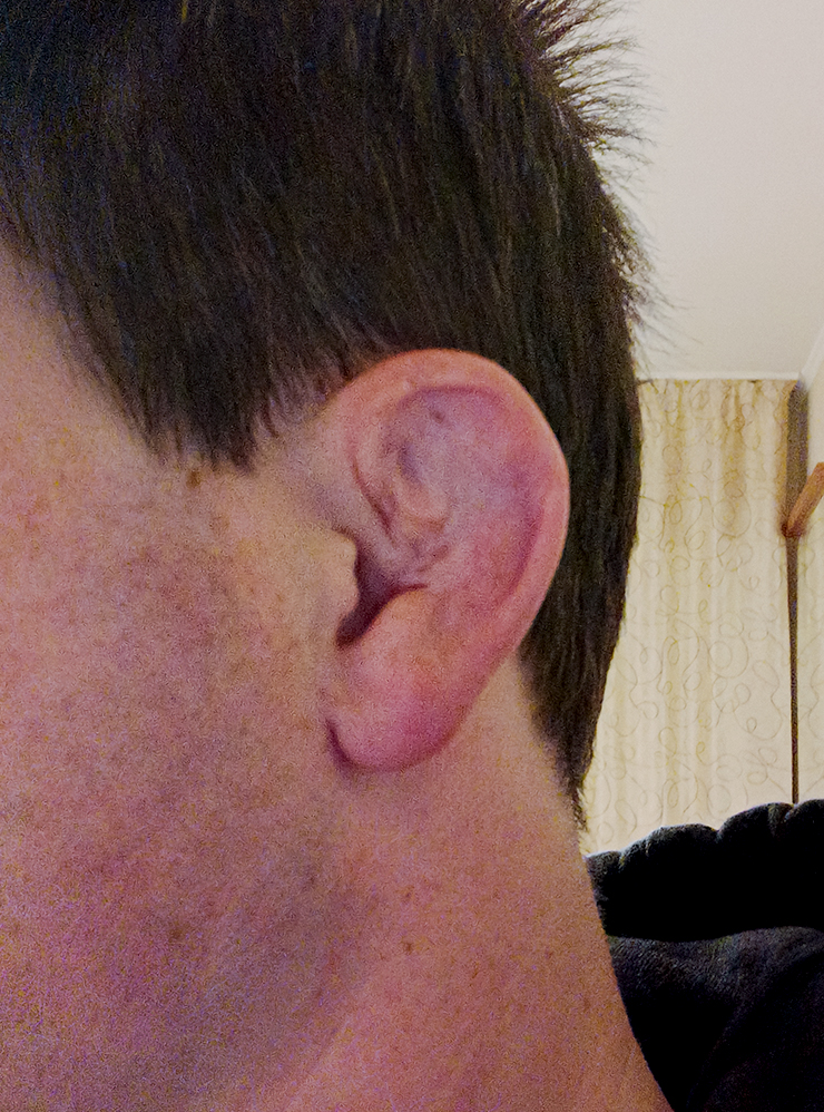 Травма наружного уха
