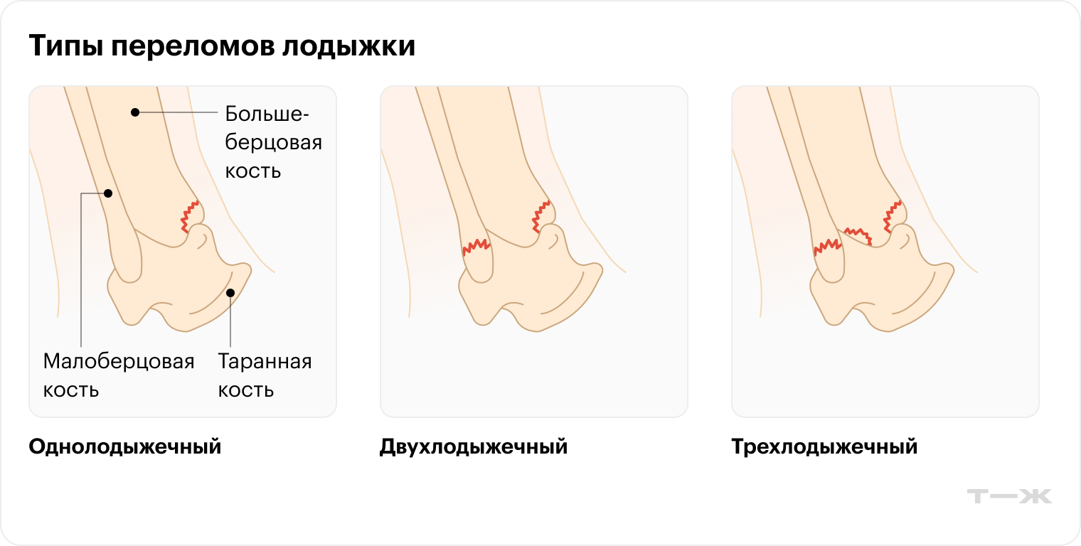 Переломы области голеностопного сустава (перелом лодыжки)