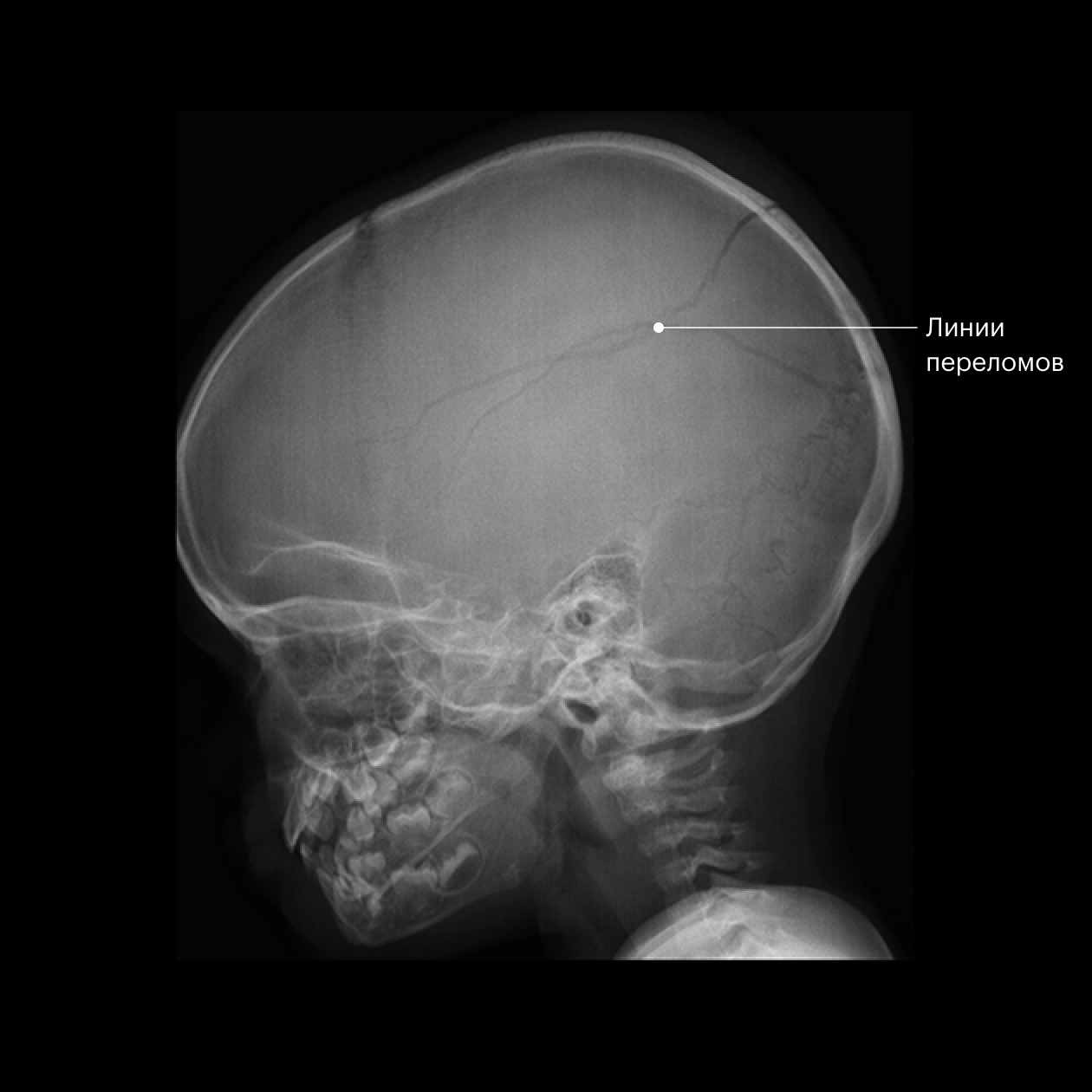 Линейные переломы обеих теменных костей на рентгенограмме. Источник: pediatricimaging.org