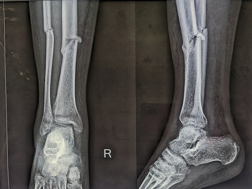 Перелом костей голени на рентгене. Источник: Ktkrypton / Shutterstock