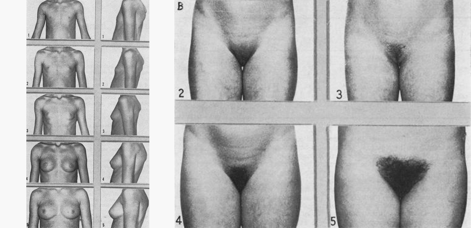 Стадии развития молочных желез и оволосения паха у девочек. Источник: pmc.ncbi.nlm.nih.gov