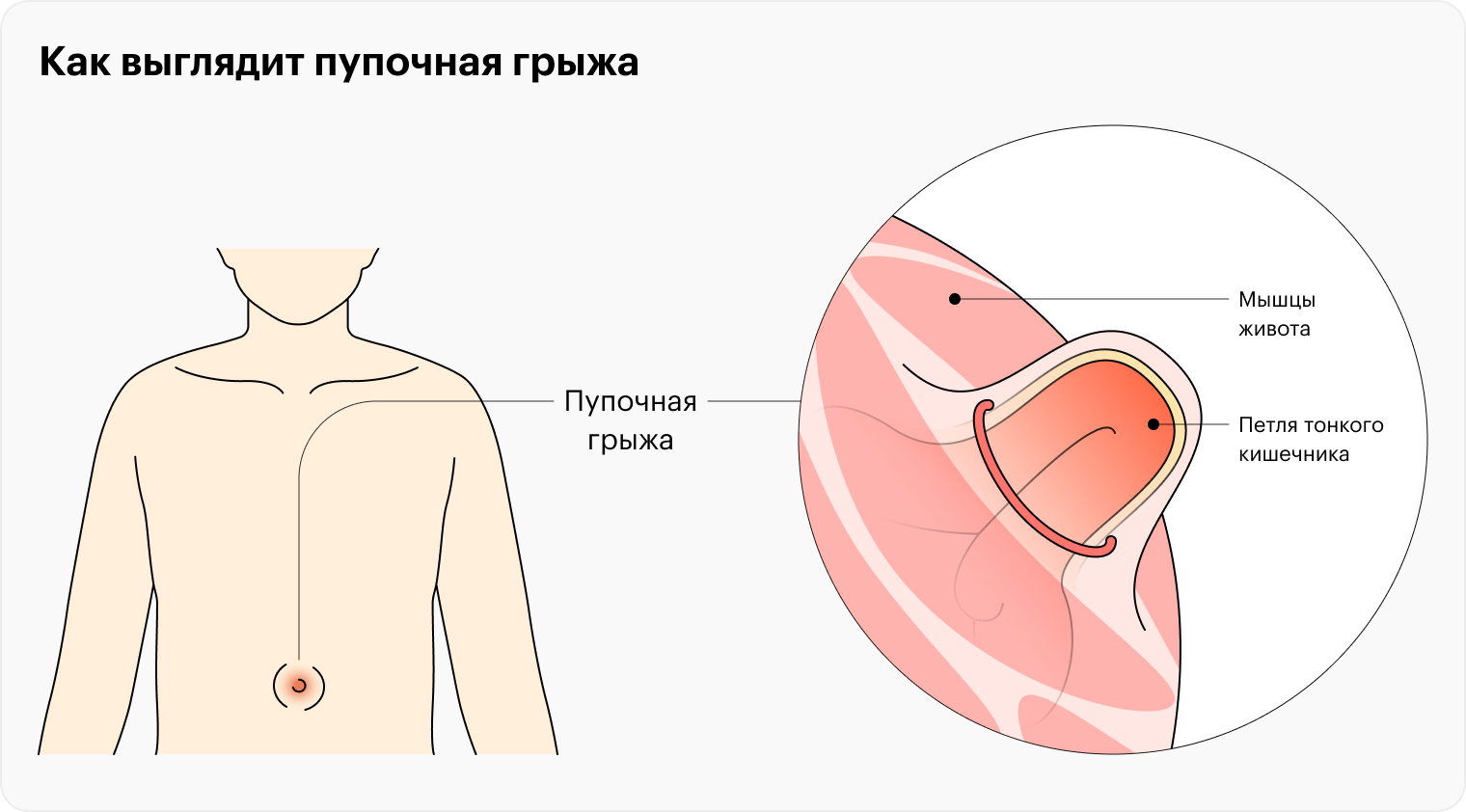 Пупочная грыжа: симптомы, операция, восстановление после удаления грыжи