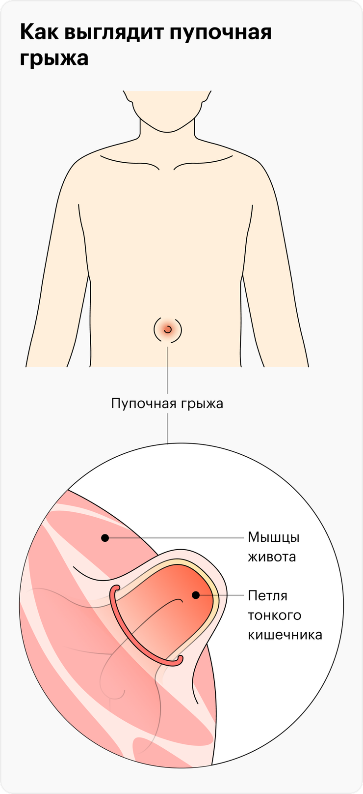 Пупочная грыжа: симптомы, операция, восстановление после удаления грыжи