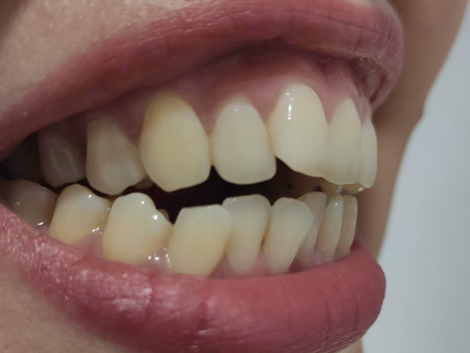 Как я поставила брекеты после 35 лет