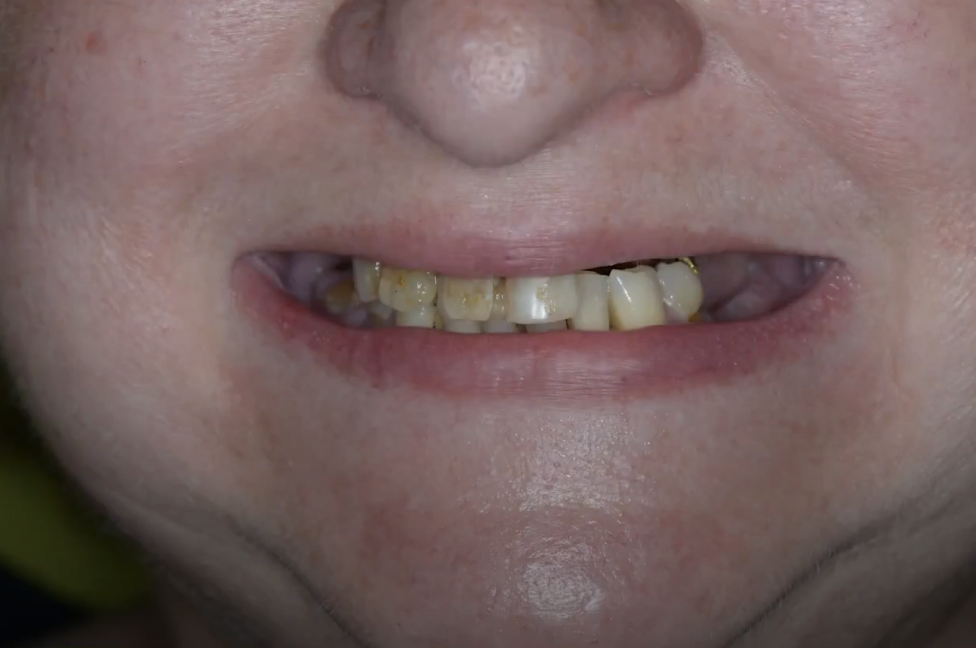 Как я восстанавливаю улыбку за 971 040 ₽