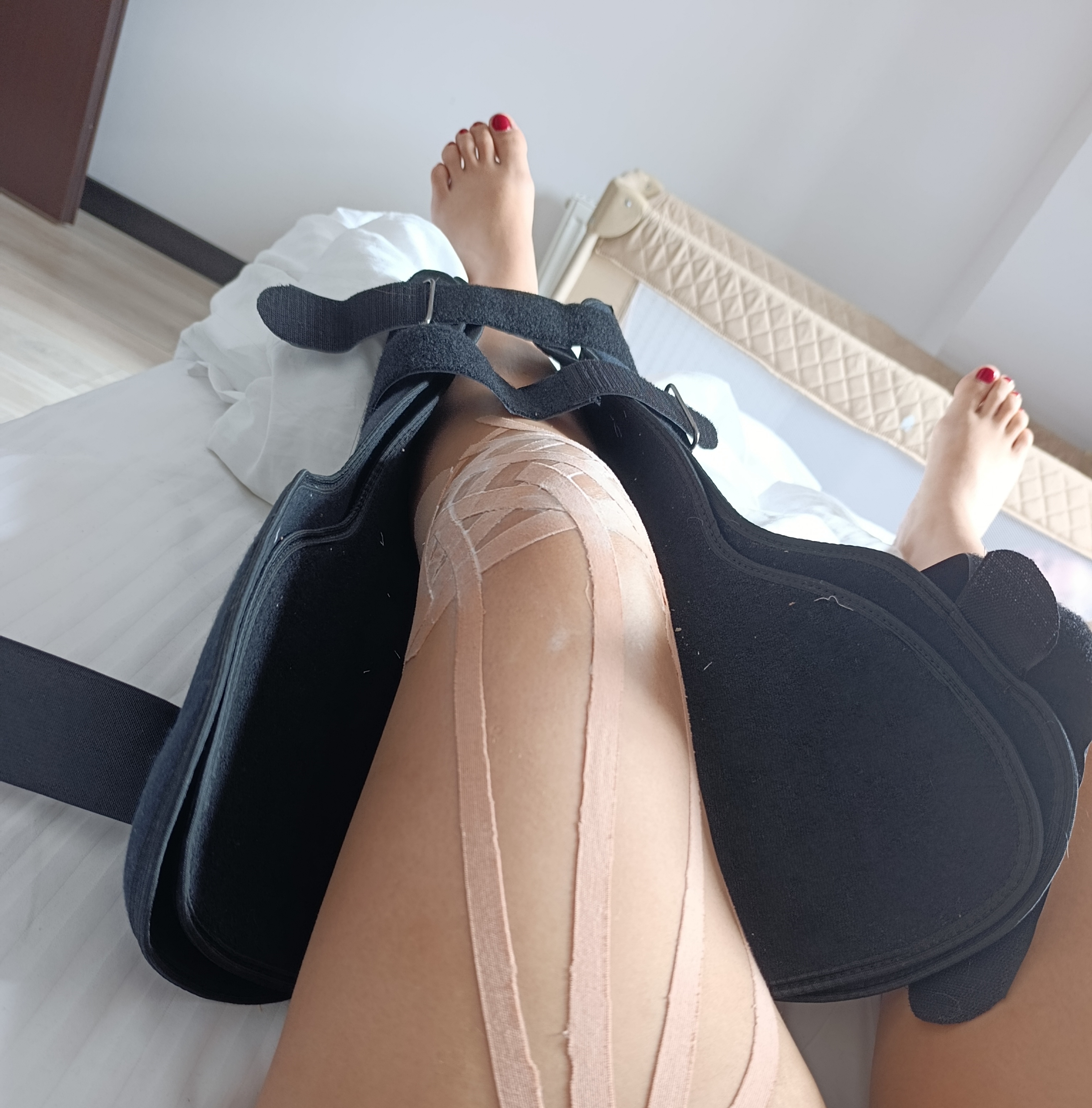 «Больничный не покрыл и половины»: как я сломала ногу, когда каталась на лыжах