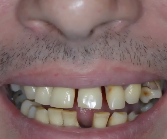 Как я восстановил зубы после 25 лет курения за 1 207 120 ₽