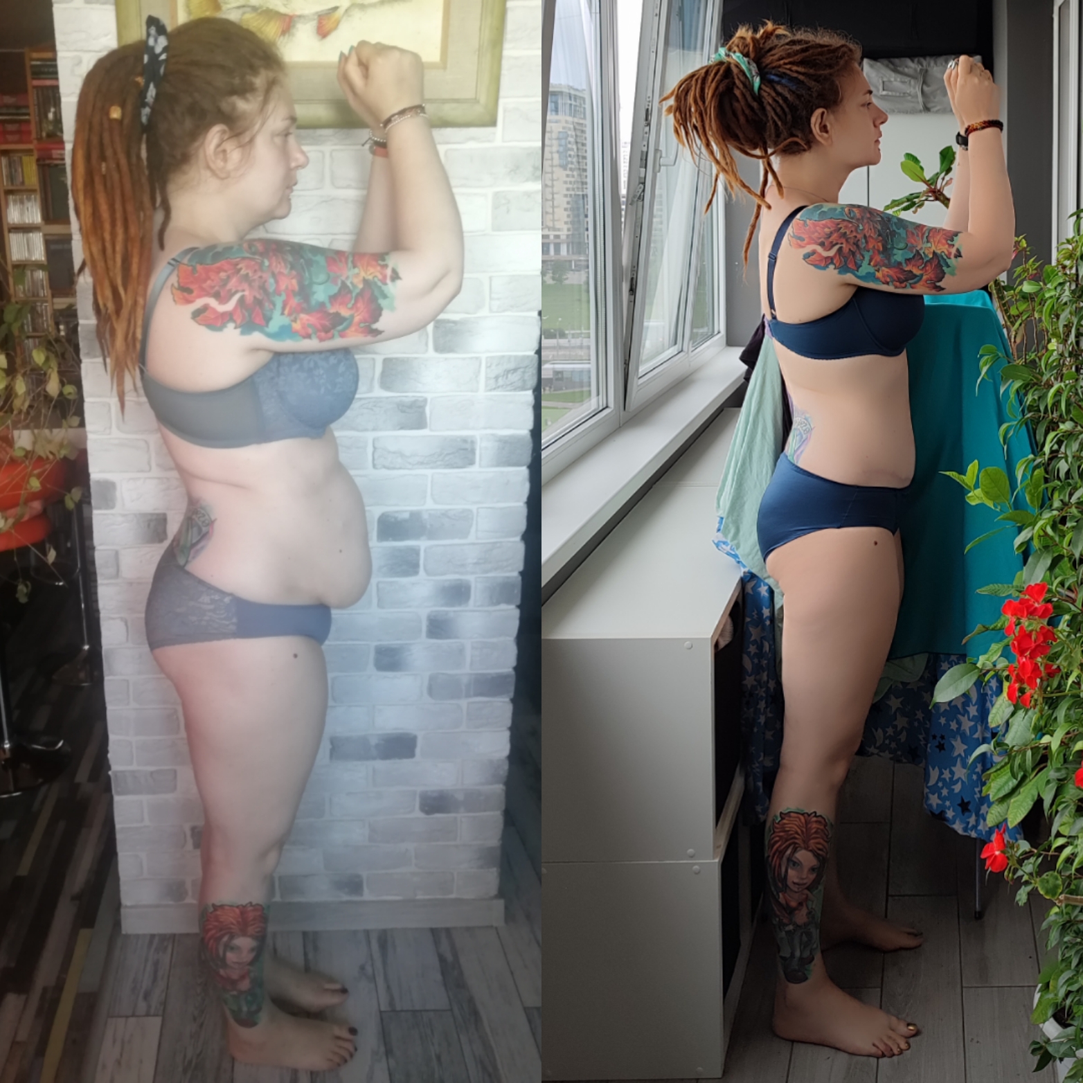 Как мне сделали абдоминопластику