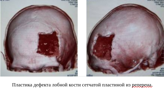 Краниопластика: как восстанавливают целостность черепа после серьезных травм