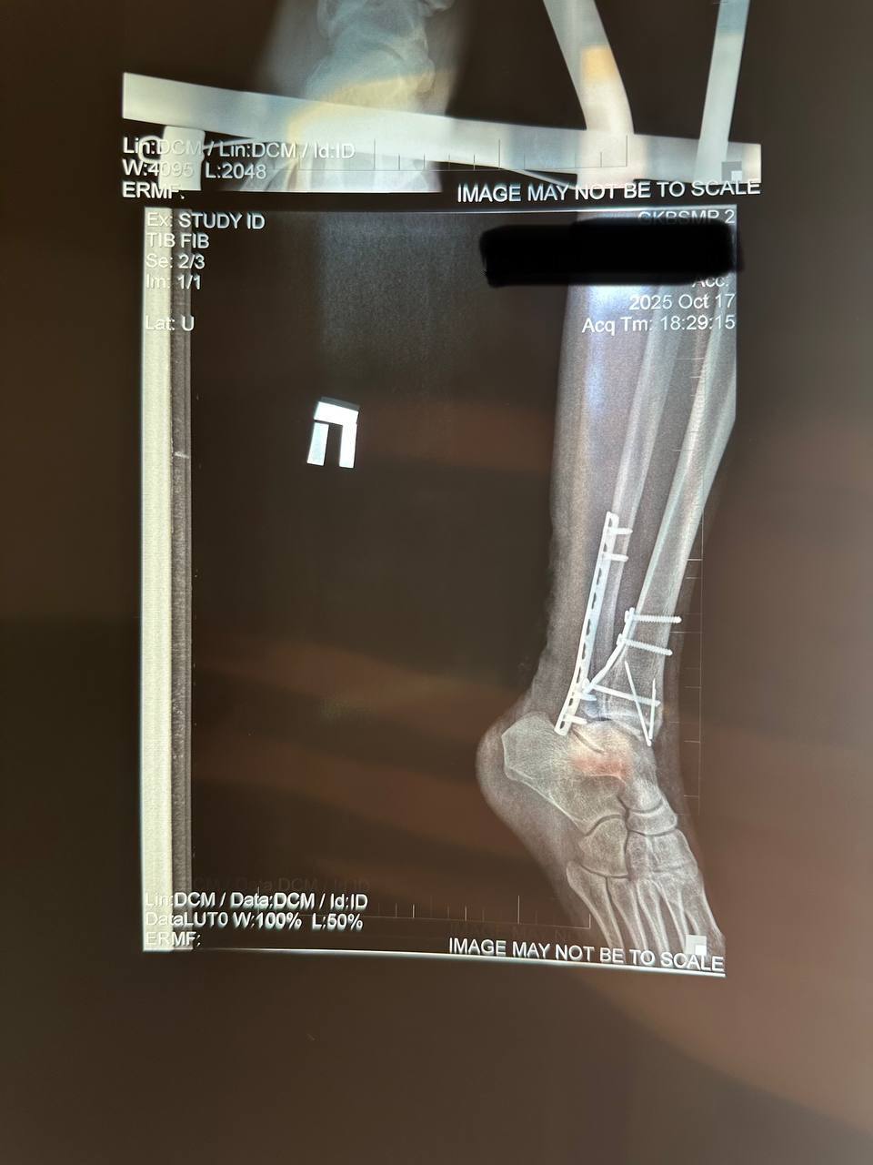 Как я получила тройной перелом голеностопа, пережила три операции и учусь жить заново