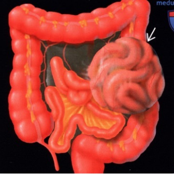 Как у меня начались длительные проблемы с ЖКТ после пищевого расстройства