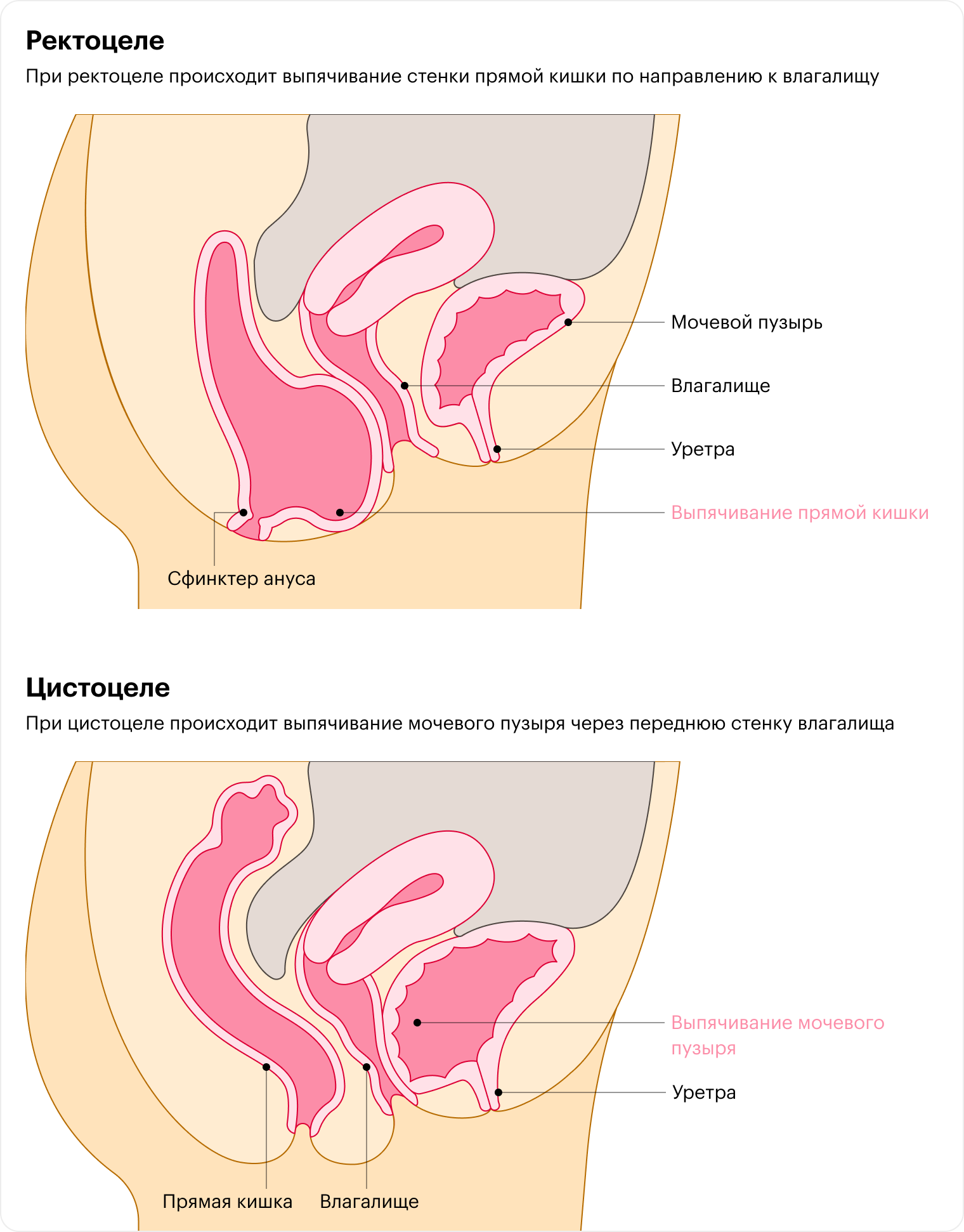 Сила мышц тазового дна у женщин после родов и влияние на нее консервативных методов лечения