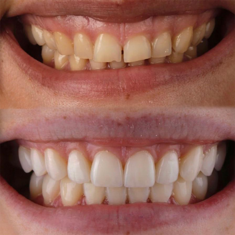 Верхний ряд — зубы до лечения, нижний — после установки виниров. Фото: Александр Лапыко