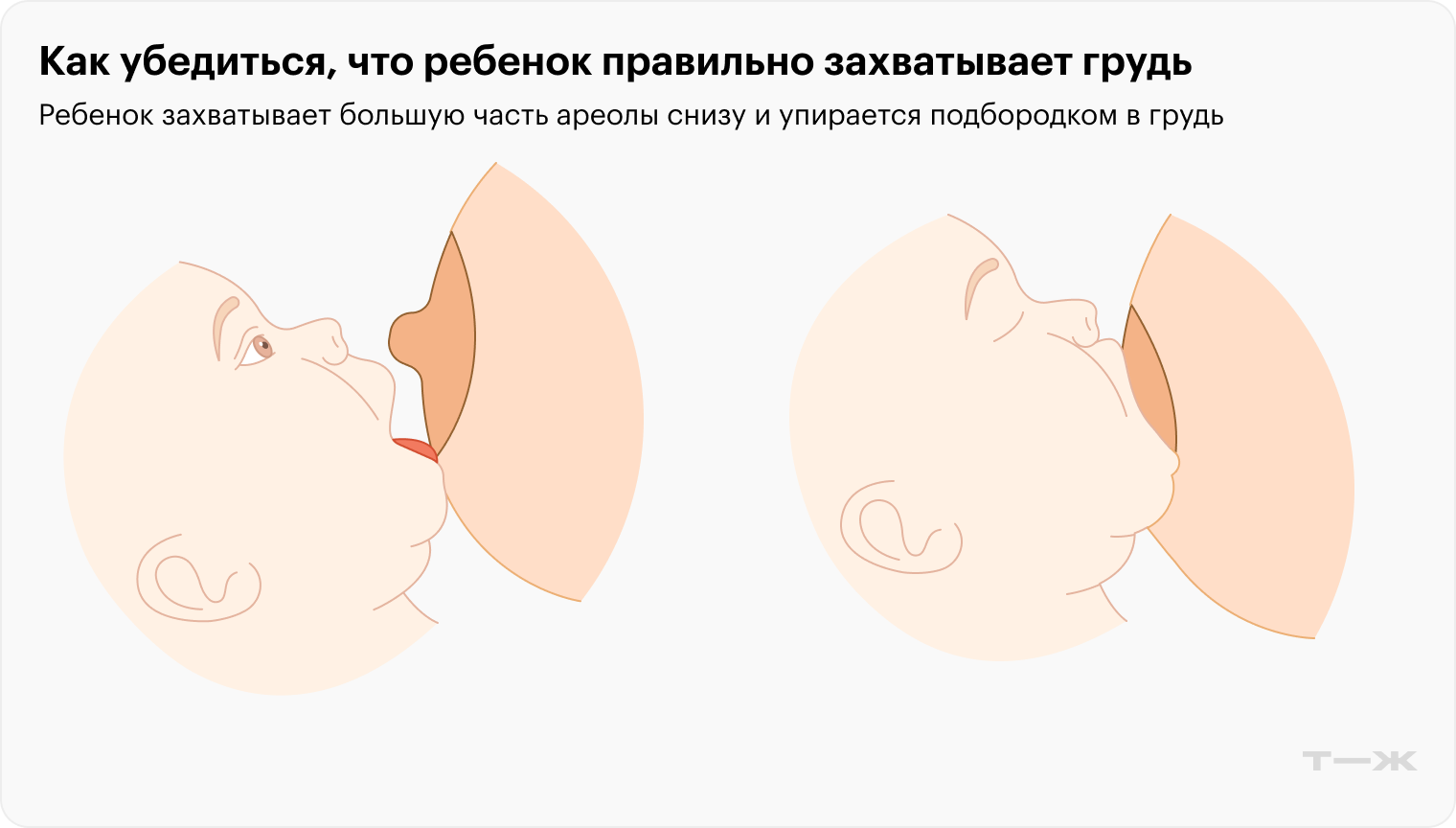 Ребенок правильно приложен к груди: он захватывает большую часть ареолы снизу и упирается подбородком в грудь. Источник: uptodate.com