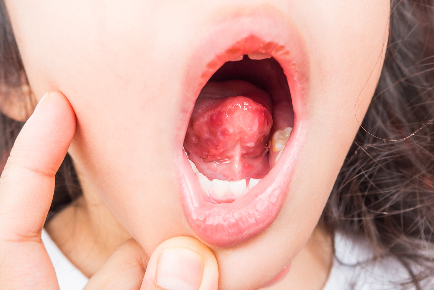 Язвы во рту при вирусной пузырчатке полости рта и конечностей. Источник: Arlee.P / Shutterstock