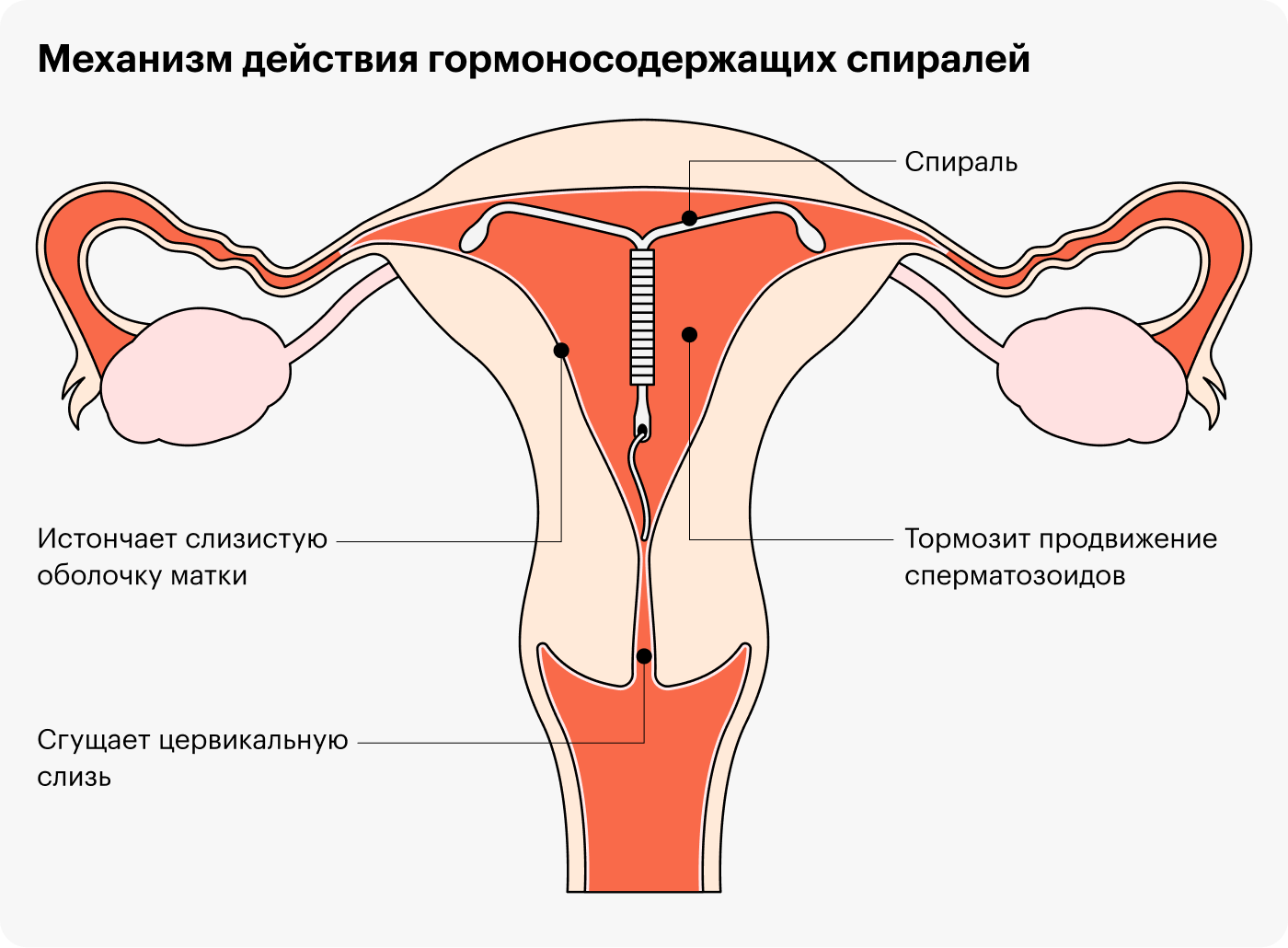 Внутриматочная спираль: все об этом методе контрацепции