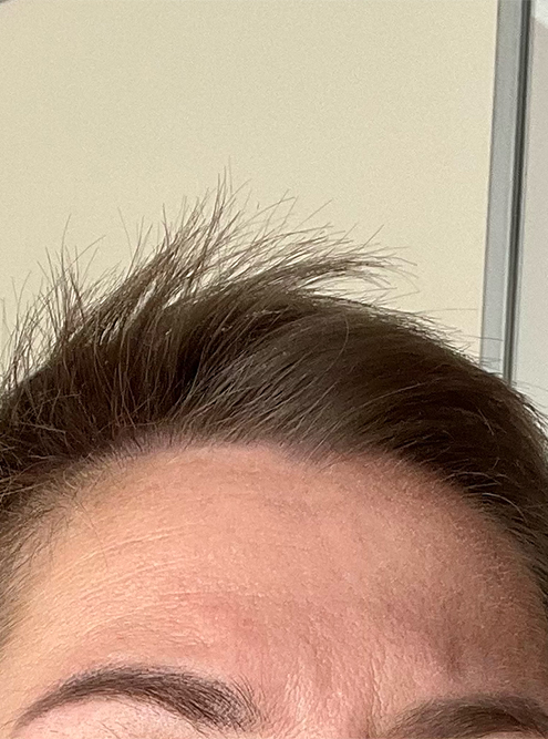 Линия роста волос через пару месяцев после пересадки