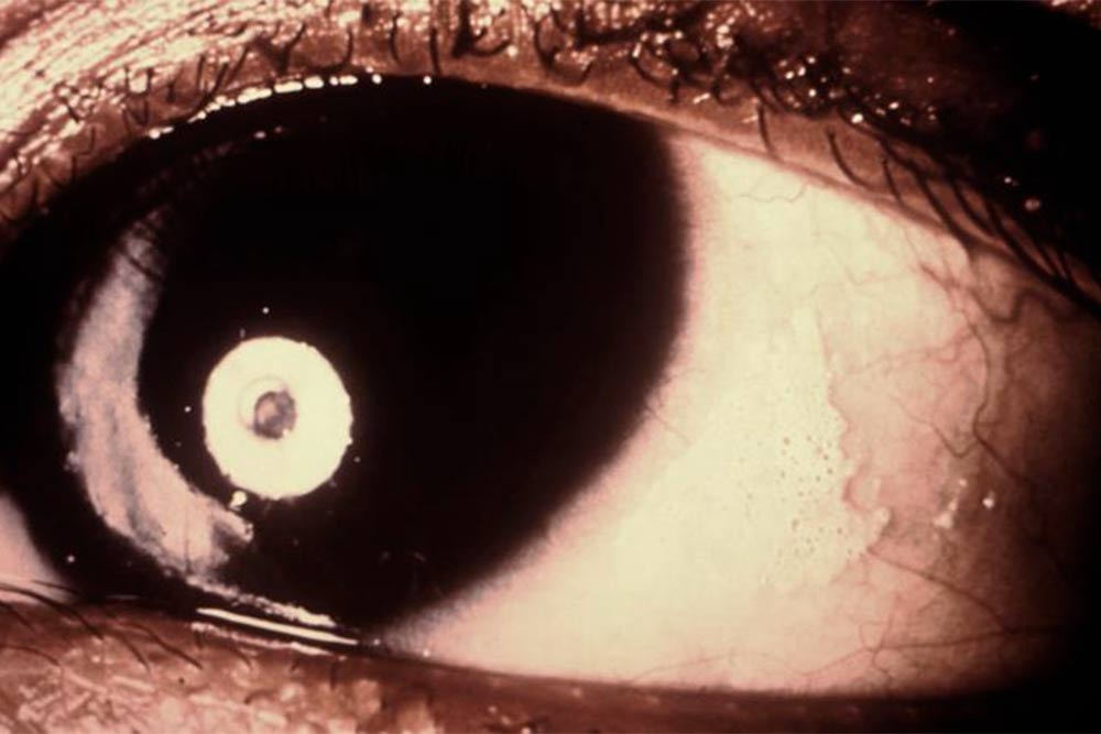 Ксерофтальмия. На роговице глаза справа видно ороговевшее пятно, которое образовалось из-за нехватки слез. Источник: справочник для врачей MSD