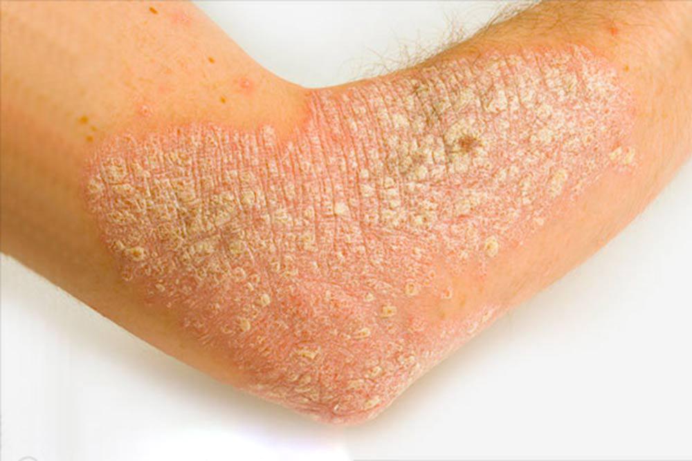Гиперкератоз. Утолщение кожи выглядит как шелушащееся пятно. Источник: интернет-ресурс Medindia