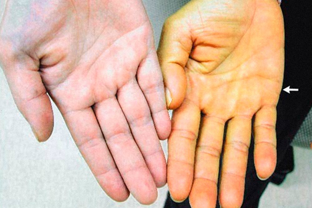 Слева — ладонь обычного цвета. Справа — кожа окрасилась из-за бета-каротина. Источник: медицинский журнал NEJM