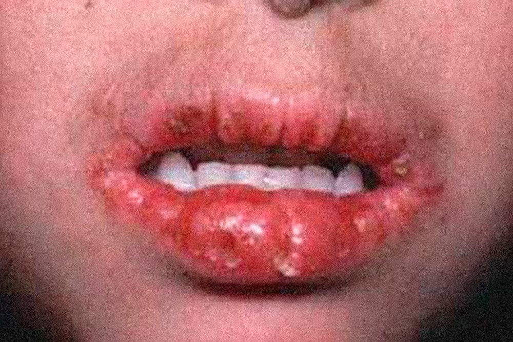 Из-за дефицита витамина В2 может развиться арибофлавиноз, один из признаков которого — трещины в уголках рта и на губах. Источник: Institute of child health