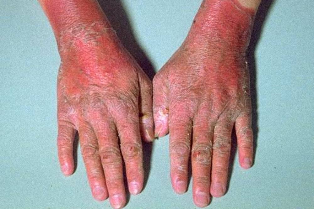 У людей с дефицитом витамина В3 часто развивается пеллагра, один из признаков которой — красные шелушащиеся руки. Источник: справочник для врачей MSD
