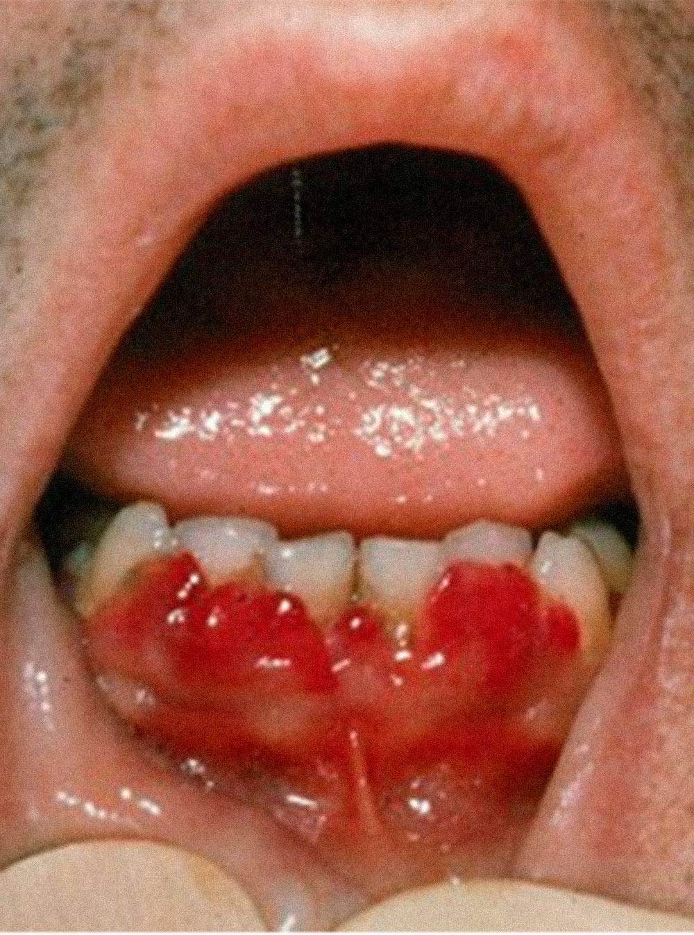 Из-за дефицита витамина С может развиться цинга, один из признаков которой — разрушение десен. Источник: справочник медицинских иллюстраций GrepMed