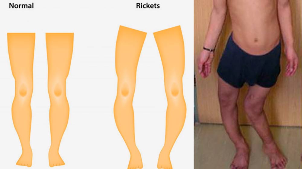 Слева — ноги ребенка, который получает достаточно витамина D. Справа на иллюстрации и фотографии — ноги ребенка с рахитом. Источник: справочник для студентов Миннеаполисского медицинского колледжа