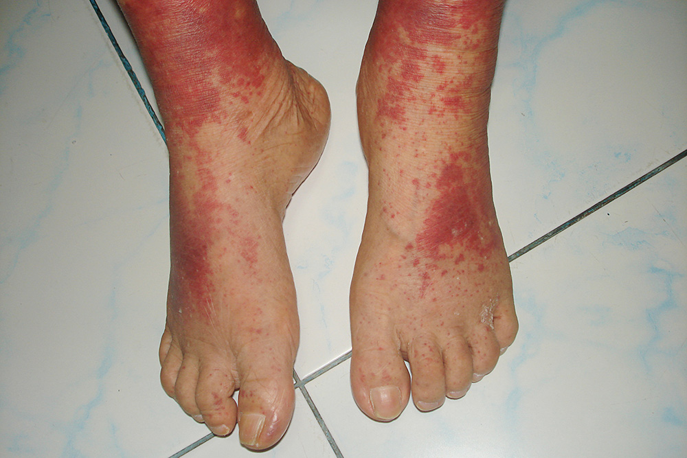 У людей с тяжелой нехваткой кальция могут развиваться петехии — подкожные кровоизлияния. Источник: LoyFah4158 / Shutterstock