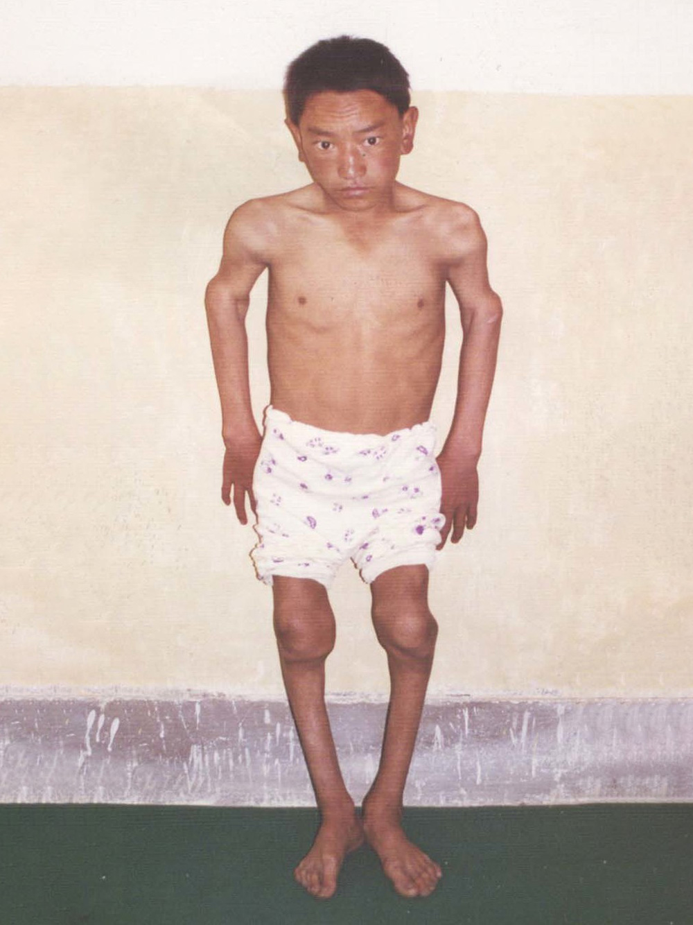 Болезнь Кашина-Бека. Источник: «Википедия»