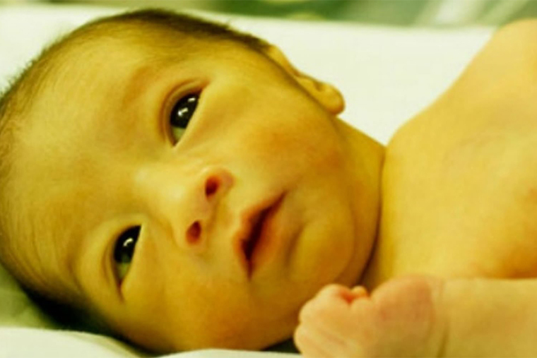 Так выглядит желтуха у новорожденного. Источник: healthservehhc.co