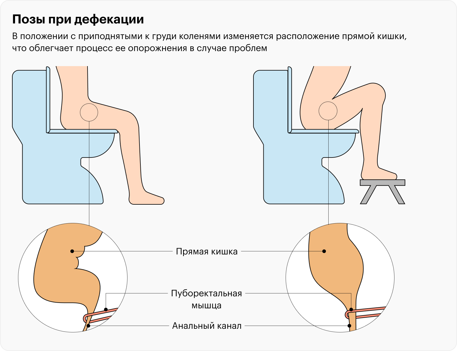 Более привычный способ сидения на унитазе не так сильно сглаживает аноректальный угол — в такой позе испражняться труднее, чем когда колени приподняты выше таза. Исправить это можно с помощью подножки — на «Яндекс-маркете» она стоит от 578 ₽