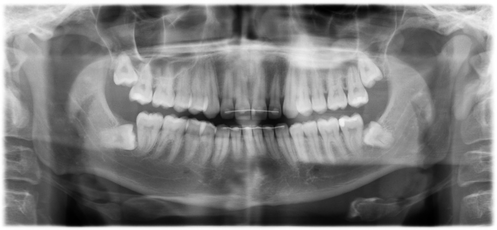 Так выглядят ретинированные зубы мудрости на специальном рентгеновском снимке — видно, что они находятся внутри десны, прорезались не полностью и под неправильным углом. Источник: radiopaedia.org